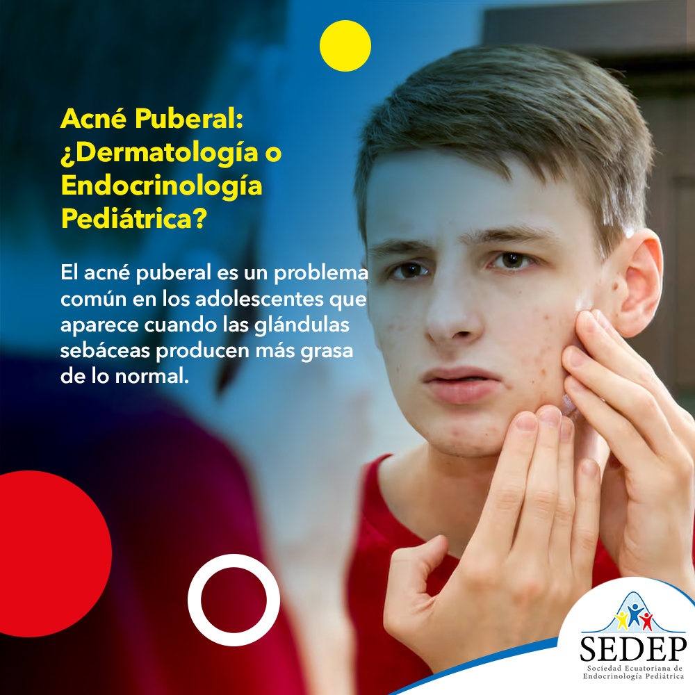 Acné Puberal: ¿Dermatología o Endocrinología Pediátrica?